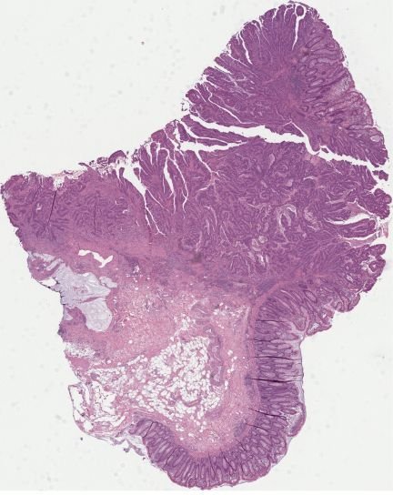 H&E whole-slide image of a colorectal resection